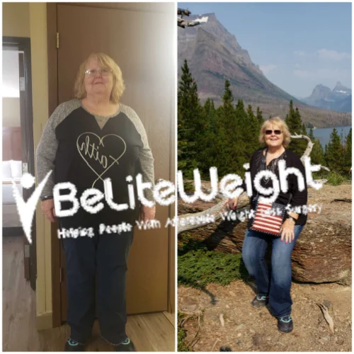 Weight Loss Surgery Gastric Sleeve before and after